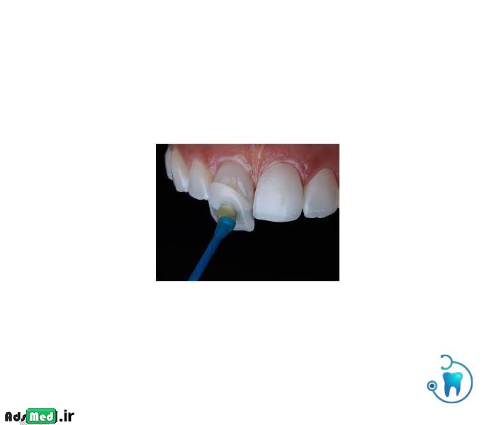 کامپوزیت دندان